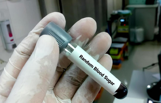 Random Blood Sugar