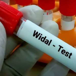Widal Test